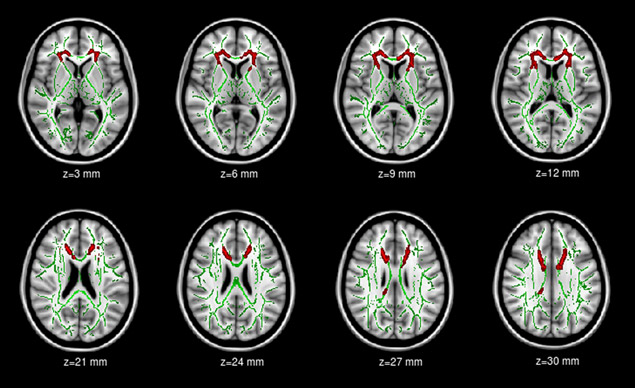 TBSS analysis of fractional anisotropy (FA) volumes. Abnormal White Matter Integrity in Adolescents with Internet Addiction Disorder.